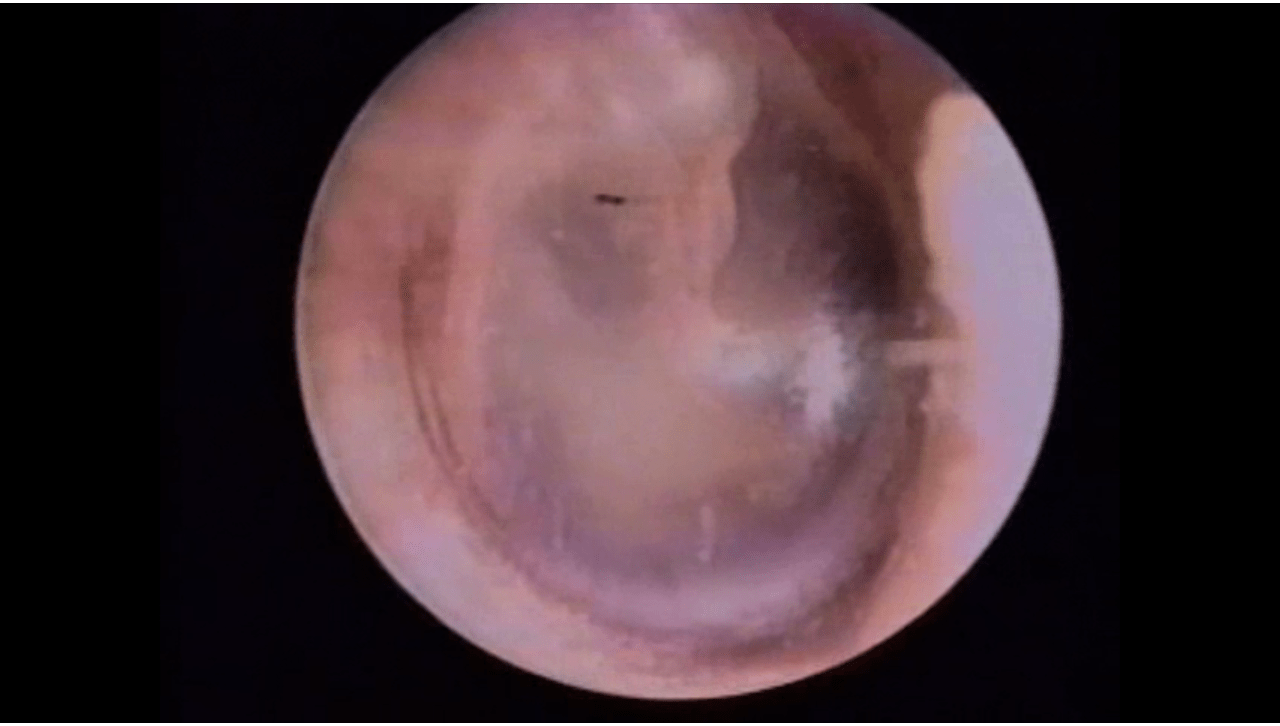 Normal Ear image