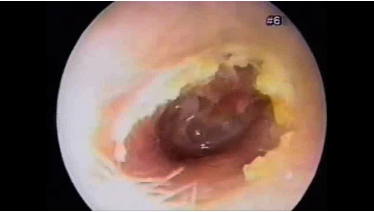 Otitis Media with Effusion (Atrophy of ear drum from old ear tubes)