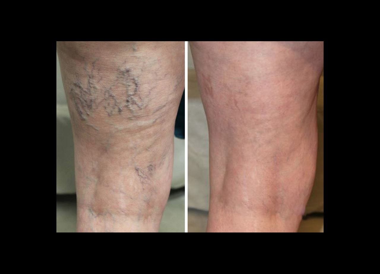 spider veins before and after image
