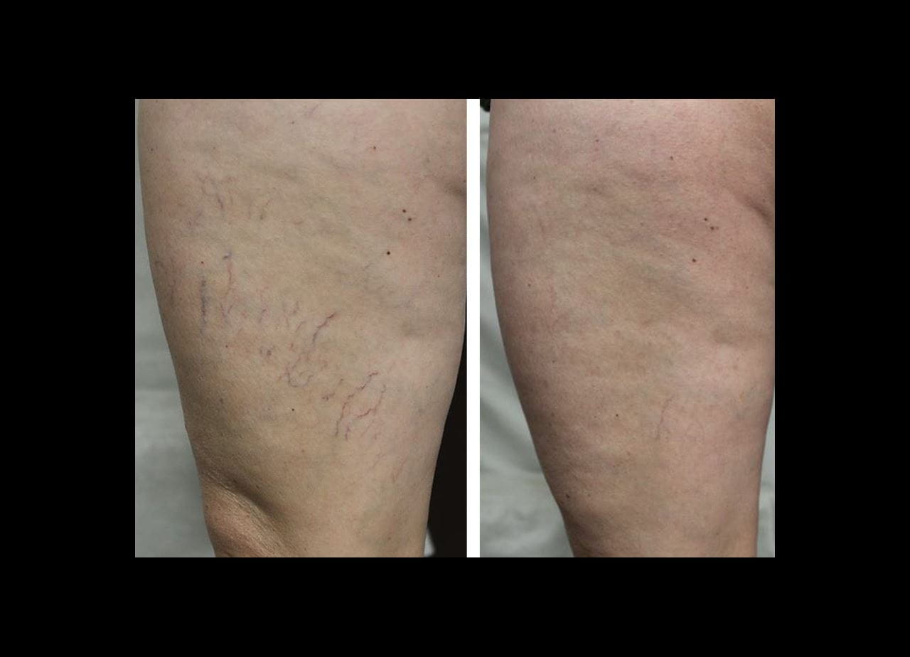spider veins before and after image