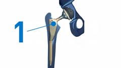 hip replacement femoral head replaced by a metal stem