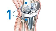 knee replacement bone preparation