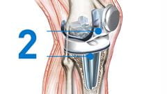 knee replacement Implant positioning