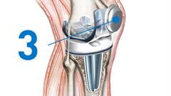 knee replacement resurfacing