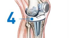 knee replacement Spacer insertion