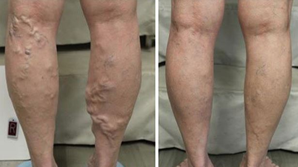 before and after image of vein treatment