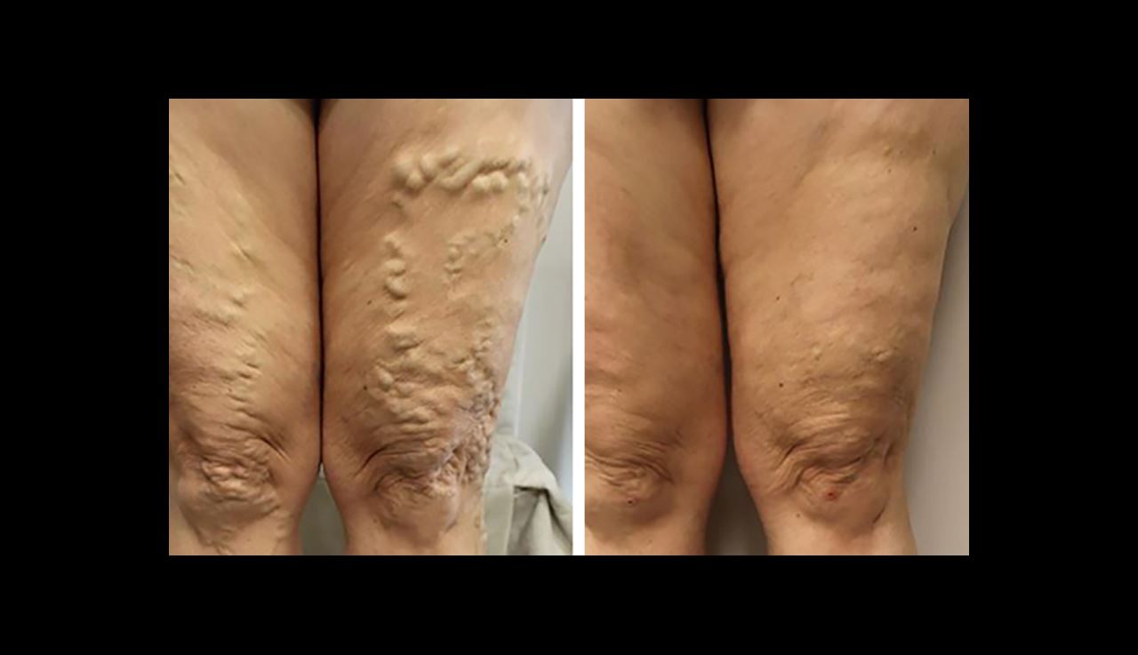 varicose veins on the leg before and after results