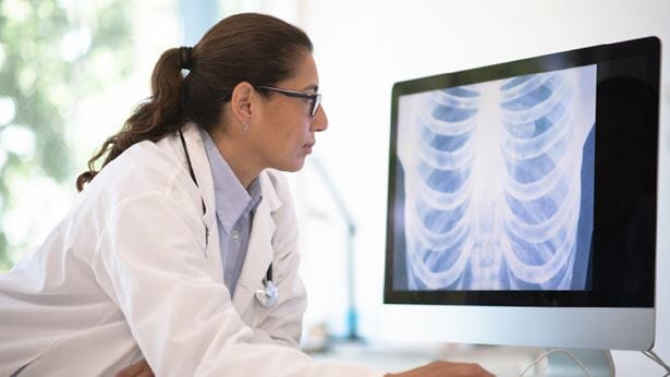 Doctor looking at lung cancer x-rays