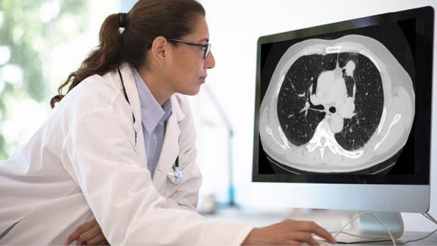 Doctor looking at lung cancer xray