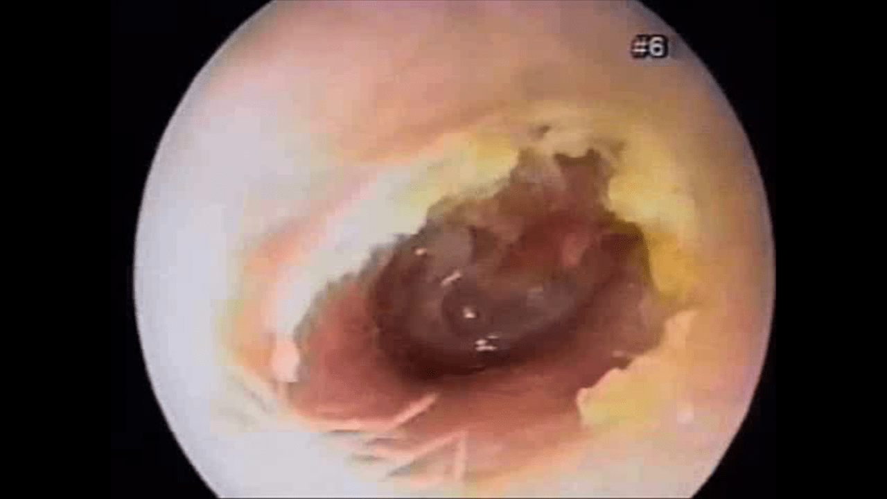 Otitis Media with Effusion (Atrophy of ear drum from old ear tubes)