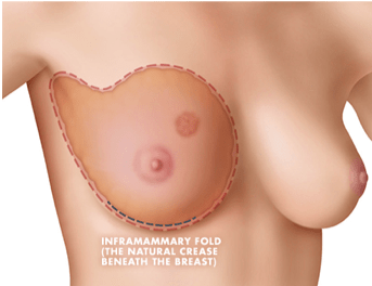 Hidden Scar NippleSparing Masectomy