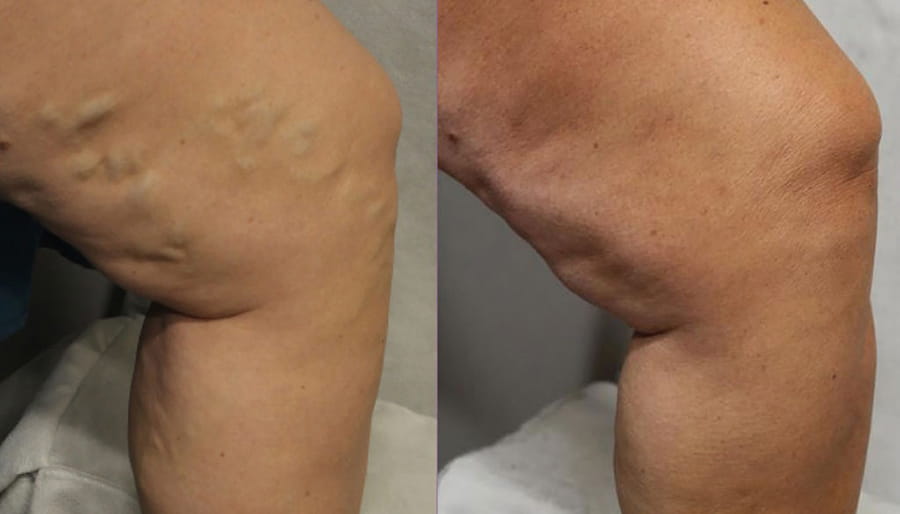 varicose veins before and after image