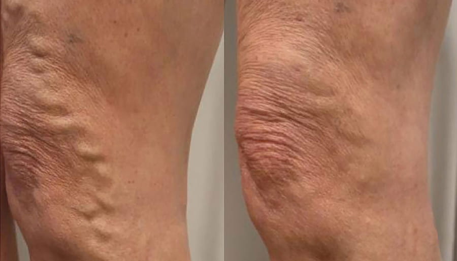 varicose veins before and after image