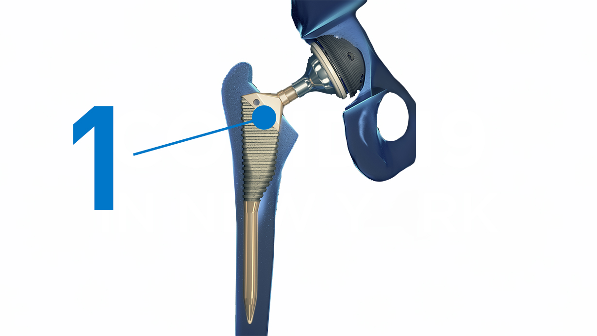 hip replacement femoral head replaced by a metal stem