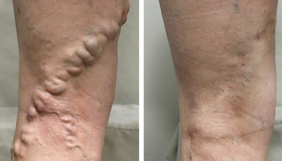 varicose veins before and after results