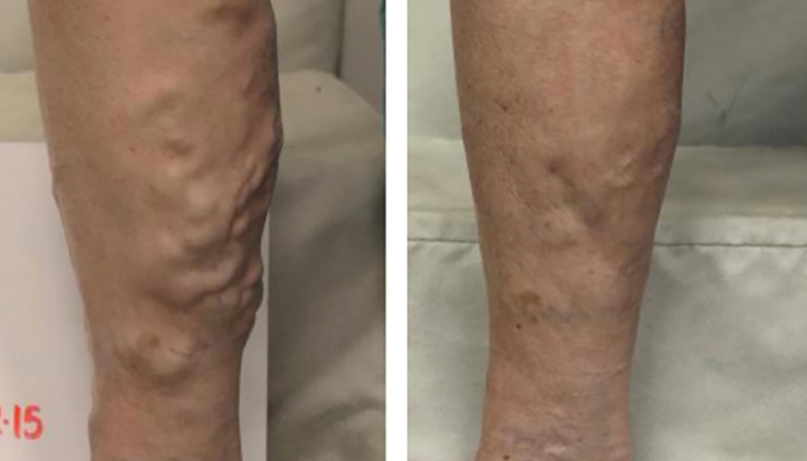varicose veins on the leg before and after results