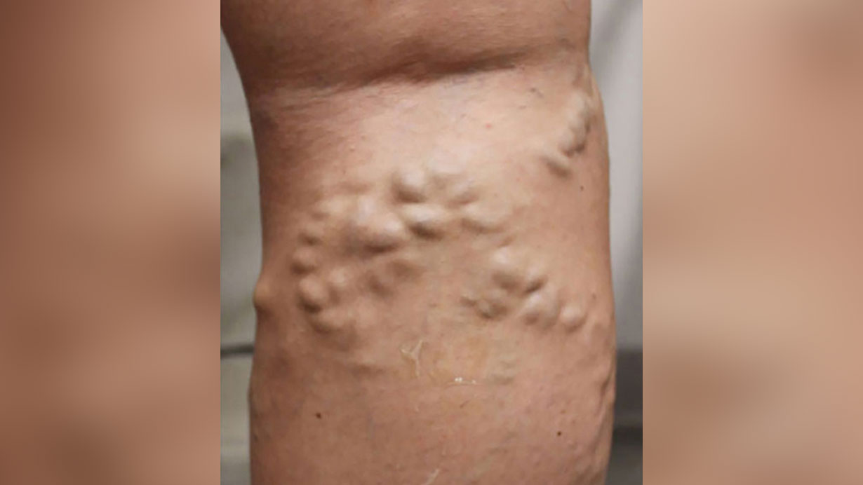 varicose veins on the back of a leg